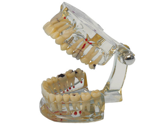 MODELO TRANSPARENTE CON CARIES
