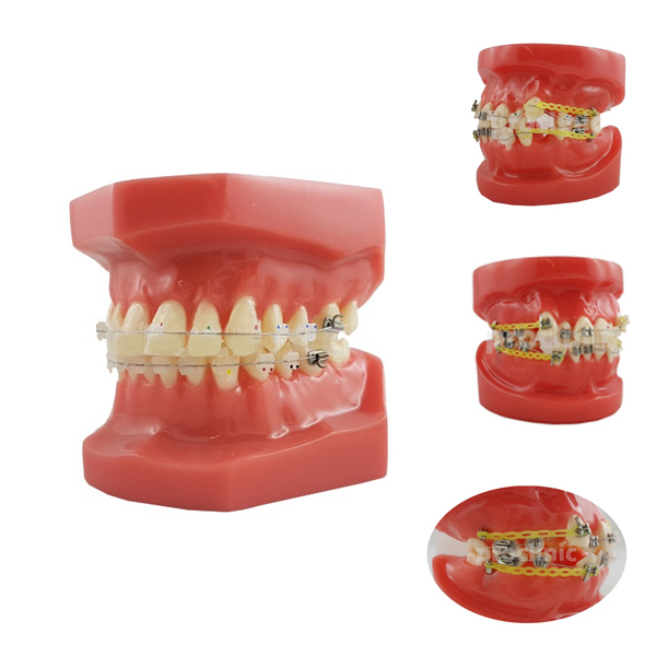 MODELO DE BRACKETS DE CERAMICA Y METAL