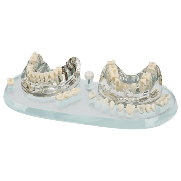 MODELO ESTUDIO IMPLANTES Y PROTESICOS
